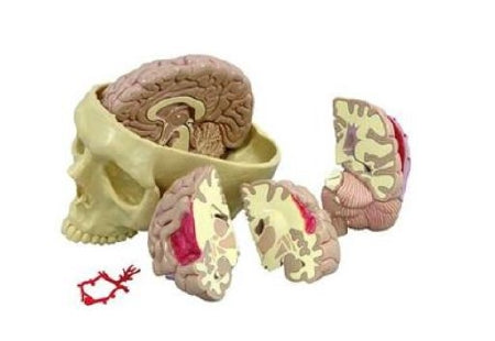 Anatomical Chart Company Diseased Brain in Skull Model Life Size - G290