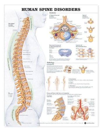 Anatomical Chart Company Anatomical Chart Spine Disorders 20 X 26 Inch Heavy Paper Grommets Laminated - 9781587793998