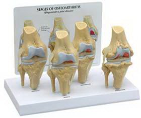 Alimed GPI Anatomicals 4 Stage Osteoarthritis Knee Model - 70573