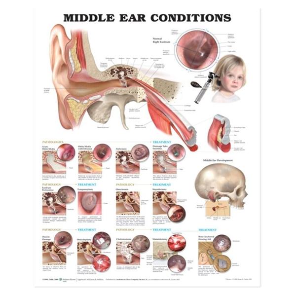 Wolters Kluwer Health Inc Chart Anatomical Middle Ear Conditions 20X26" Ea - 9781605470962
