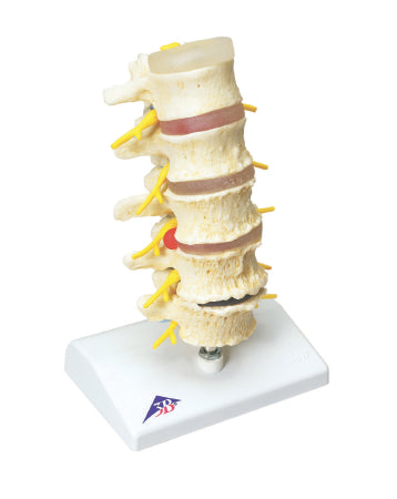 Fabrication Enterprises Vertebrae Degeneration, Stages of Prolapsed Disc Model 2 lbs. - 965307