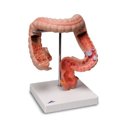 3B Scientific - Intestinal Diseases Model 2.11 lbs. - Z02807
