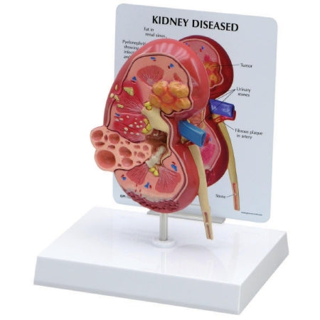 3B Scientific - Diseased Kidney Model - Z02805