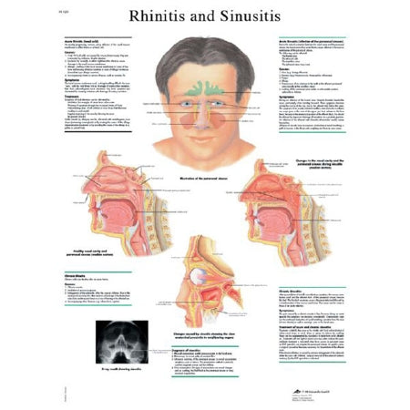 Fabrication Enterprises 3B Scientific Anatomical Chart Rhinitis and Sinusitis 19-7/10 X 26-2/5 Inch UV Resistant Paper Laminated - Z13398