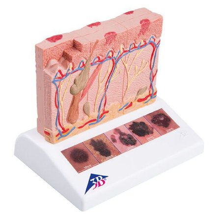 Fabrication Enterprises 3B Scientific Skin Cancer Model .44 lbs. - Z13802