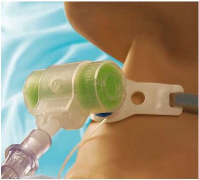 Intersurgical Hydro-Trach T Mk II HME Tracheostomy Tube - 1873030