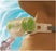 Intersurgical Hydro-Trach T Mk II HME Tracheostomy Tube - 1873030