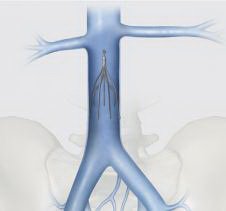 Celect - Platinum Vena Cava Filter - G34502