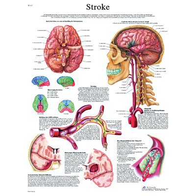 Fabrication Enterprises - Anatomical Chart Stroke 20 X 27 Inch Laminated - 12-4629L
