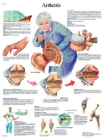 Fabrication Enterprises - Anatomical Chart Arthritis 20 X 26 Inch Laminated - 12-4605L