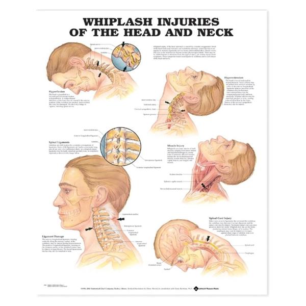 Wolters Kluwer Health Inc Chart Educational Whiplash Injuries Head/Neck 20X26" Ea - 9781587793752