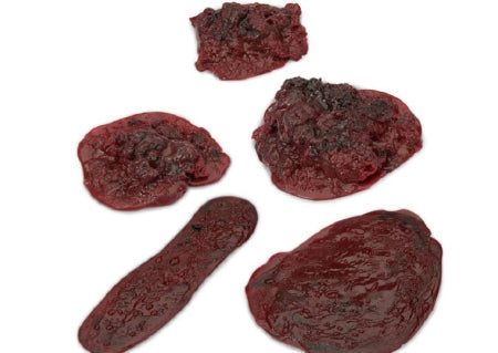 Nasco Life/Form Clots and Hemorrhages - Set of 5 - LF00714