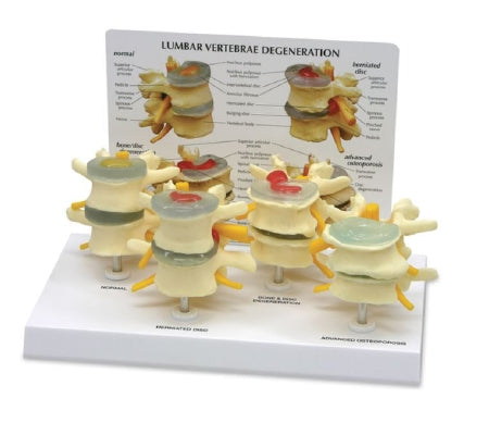 GPI Anatomicals - 4 Stage Vertebrae Model - SB35468