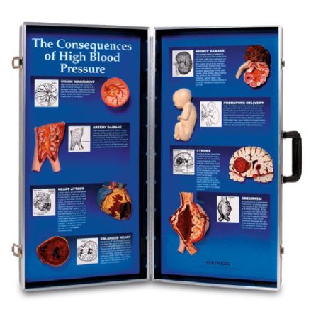Nasco Health Edco Consequences of High Blood Pressure 3-D Display - SB36973G