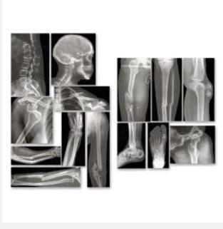 Nasco Roylco Broken Bones X-Rays - SB43367