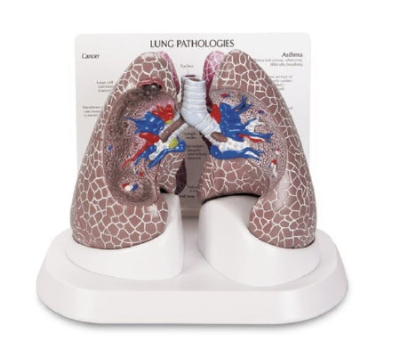 Nasco Galloway Plastics Lung Cancer Model - SB44894G