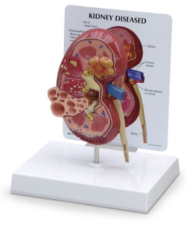 Nasco GPI Anatomicals Kidney Model w/ Pathologies - SB46337