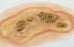 Nasco Moulage Sciences & Training MST Large Ulcer Moulage, Light Skin Color - Single - SB50208