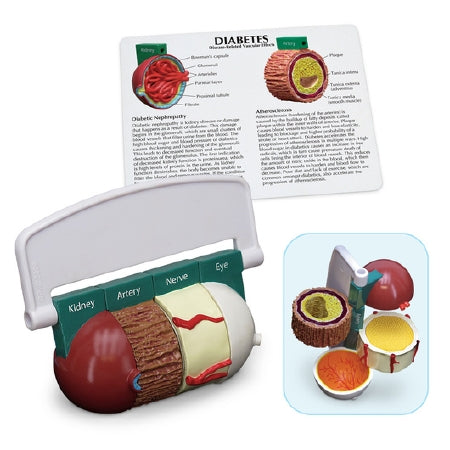 Nasco Diabetes Model - WA29777R