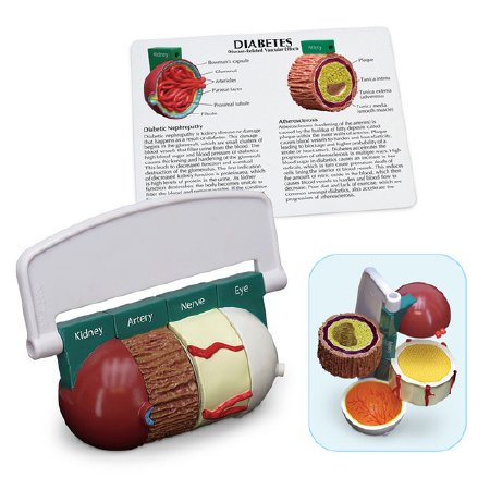 Nasco Healthcare - Diabetes Model - WA29777
