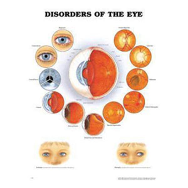 Wolters Kluwer Health Inc Chart Educational Disorder Of The Eye 20X26" Ea - 9781587799259