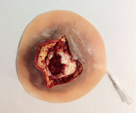 Simulaids Moulage Open Humerus Fracture Plastic - 800-607