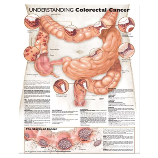 Wolters Kluwer Health Inc Chart Educational Understanding Colorectal Cancer 20X26" Ea - 9780781773331