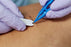 Florida Medical Sales - Suture Removal Kit - CHS85-4337