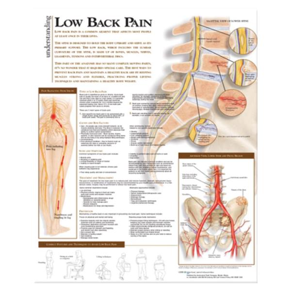Wolters Kluwer Health Inc Chart Anatomical Understanding Low Back Pain 20X26" Ea - 9780781782425