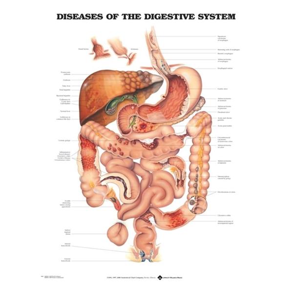 Wolters Kluwer Health Inc Chart Educational Diseases Of The Digestive System English 20X26" Ea - 9781587792366
