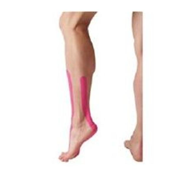 Spidertech. (NuCap Med) Tape Kinesiology Spidertech 100% Cotton/Poly Acrylic Pre Cut Adhs Blue 10/Box - TB22062-503