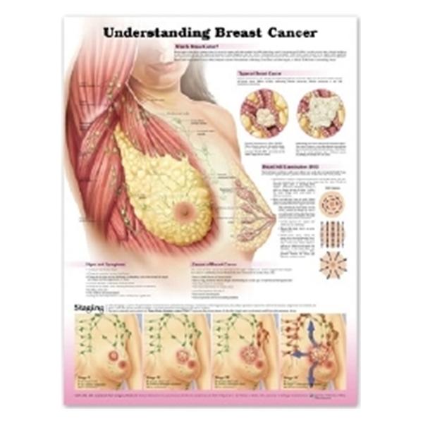 Wolters Kluwer Health Inc Chart Anatomical Understanding Breast Cancer English 20X26" Ea - 1451185645