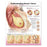 Wolters Kluwer Health Inc Chart Educational Understanding Breast Cancer Spanish 20X26" Ea - 9781451185645