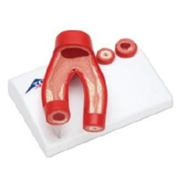 Wards Natural Science Model Arteriosclerosis 3B Scientific Ea - 470119-140