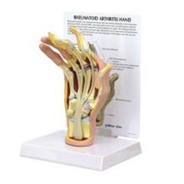 Wards Natural Science Model Rheumatoid Arthritis Hand Gpi Anatomicals Ea - 470160-248