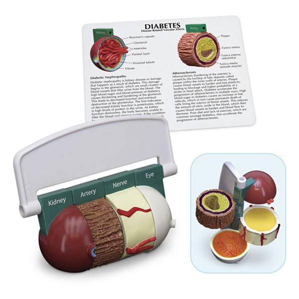 Nasco Company Diabetes Model Anatomical Ea - WA29777U