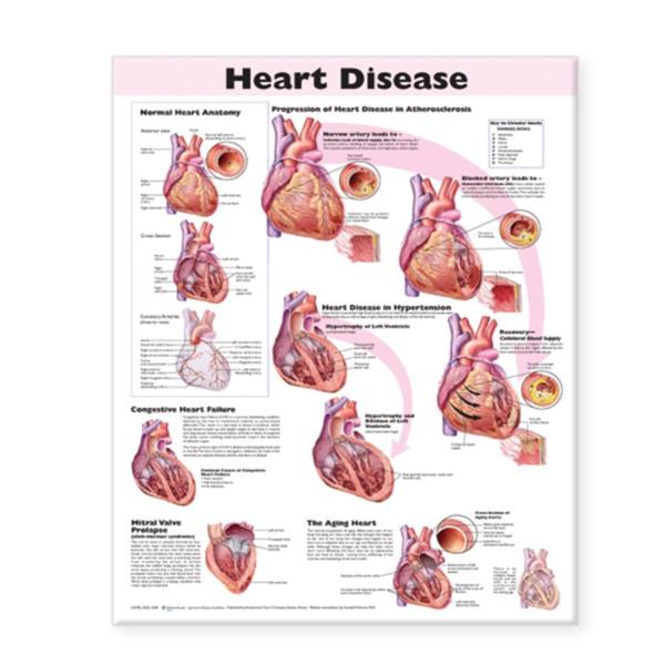 Wolters Kluwer Health Inc Poster Heart Disease 20X26" Ea - 9780781773386