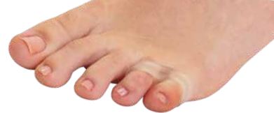 Pedifix Visco-GEL Little ToeBuddy Toe Spacer One Size Fits Most Slip-On Toe - 1035
