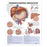Wolters Kluwer Health Inc Chart Educational Understanding Hepatitis 20X26" Ea - 9781587794186