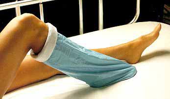 Albahealth - Stockinette Impervious 12 X 48 Inch Synthetic Sterile - 85512
