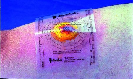 Trademark Medical Measuring Guide 3-3%XE2?%X844 X 5-1%XE2?%X842 Inch Plastic - B250