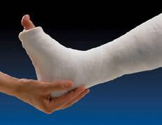 BSN Medical Gypsona HP Cast Splint 4 X 15 Inch Plaster - 30-3048