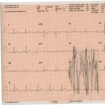 Cardinal Kendall ECG Recording Chart Paper Thermal 8-1/2 Inch X 183 Foot Fan-Fold Red Grid - 9019