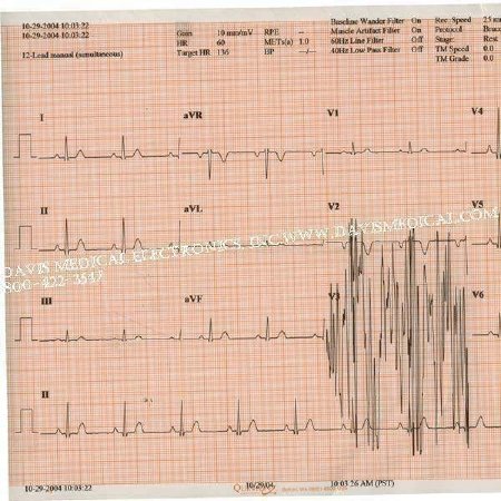 S & W Healthcare Medi-Trace ECG Recording Chart Paper Thermal 216 X 280 mm Fan-Fold Red Grid - 18416-002