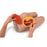 Nasco Life/Form Intramuscular Injection Simulator Teaching Guide, Supply of Syringes, and Hard Carrying Case - LF00961