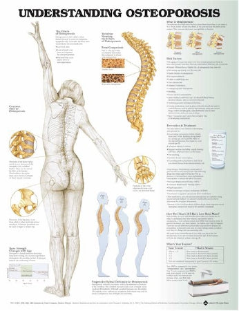 Anatomical Chart Company - Anatomical Chart Understanding Osteoporosis 20 X 26 Inch Plastic Grommets Laminated - 9781496362483