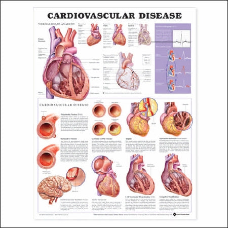 Anatomical Chart Company Anatomical Chart Cardiovascular Disease 20 X 26 Inch Plastic Wall Mount Laminated - 9781587798412