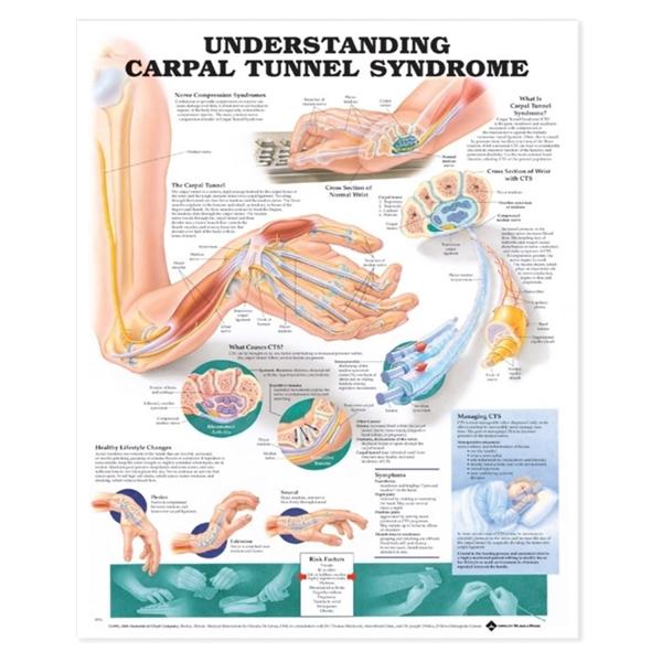 Wolters Kluwer Health Inc Chart Educational Understanding Carpal Tunnel Syndrome 20X26" Ea - 9781587793219