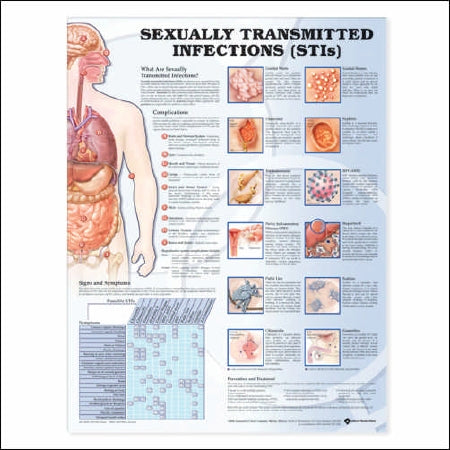 Anatomical Chart Company - Anatomical Chart Sexually Transmitted Infections (STIS) 20 X 26 Inch Plastic Wall Mount Laminated - 9781587798504