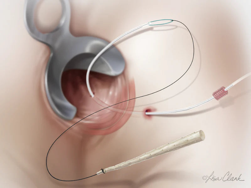 Biodesign - Anal Fistula Plug Set - G53614